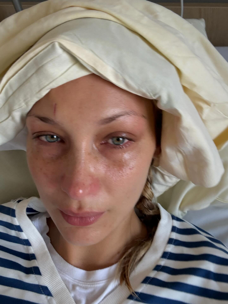 Bella Hadid talks 'medical anxiety' amid Lyme disease battle8